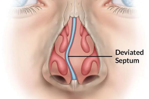 Desvio de septo nasal - Tratamento em Sorocaba